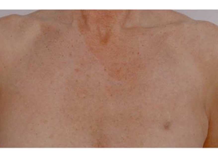 profhilo-body-after-3