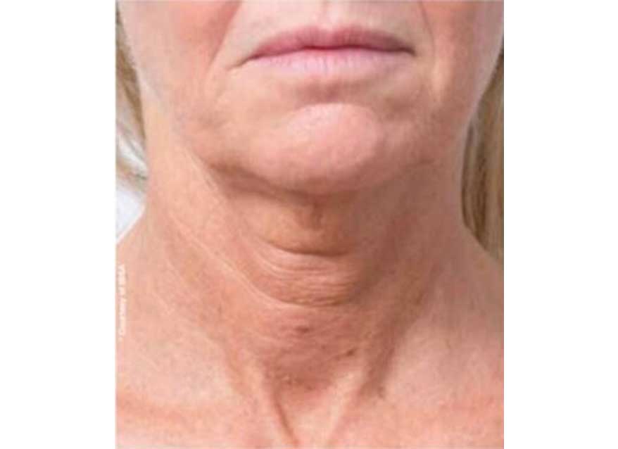 profhilo-body-before-2