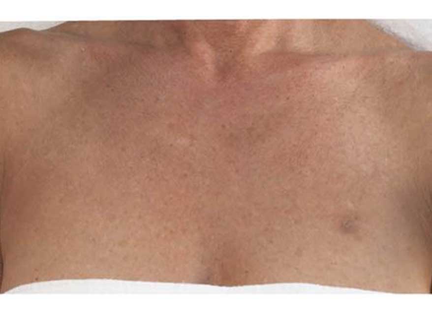 profhilo-body-before-3