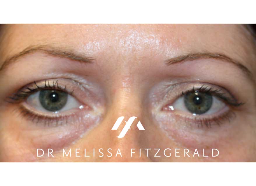 browlift-after-1