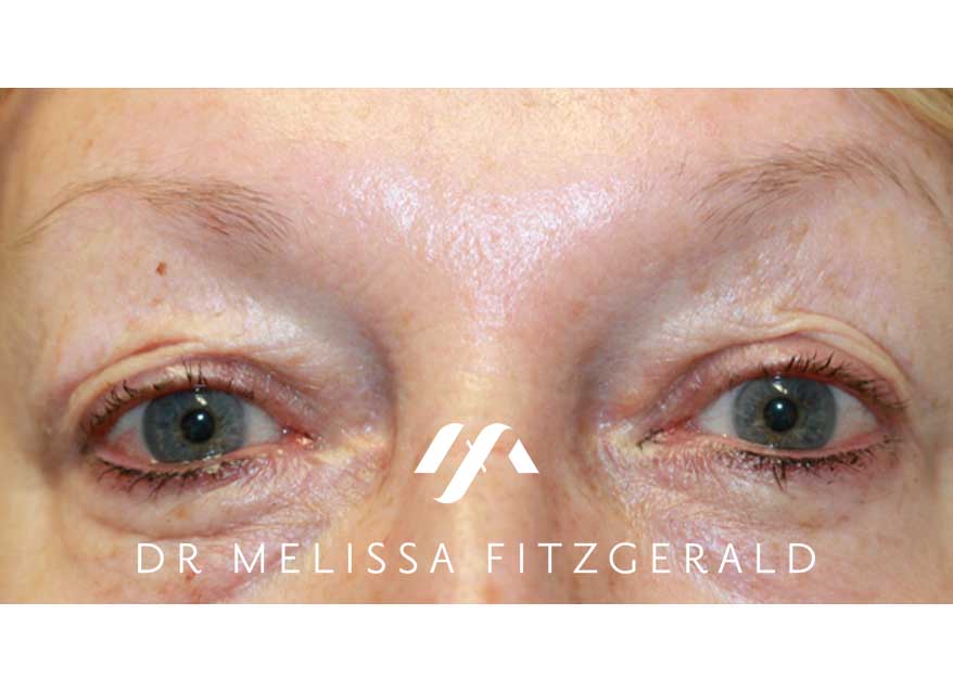 browlift-after-2