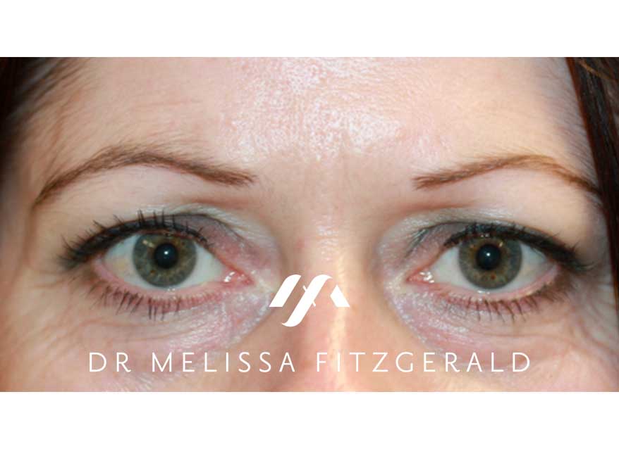 browlift-before-1