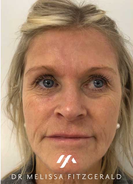 sculptra-after-1