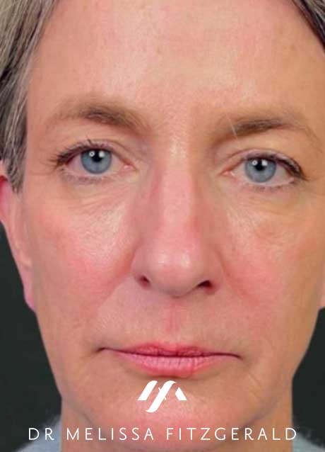 sculptra-after-2