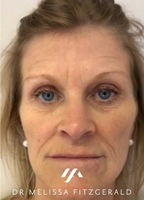 sculptra-before-1