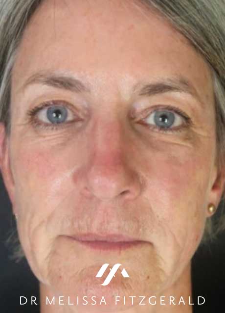 sculptra-before-2