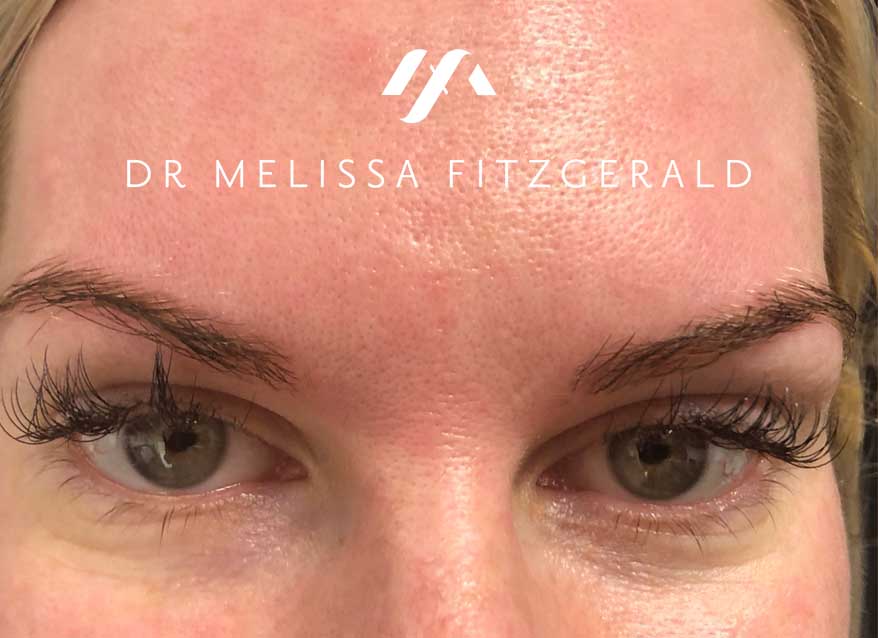 undereye-botox-after-1