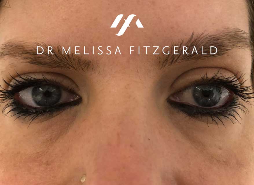undereye-botox-after-2