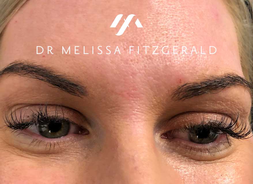 undereye-botox-before-1