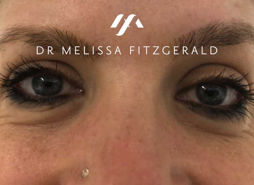 undereye-botox-before-2